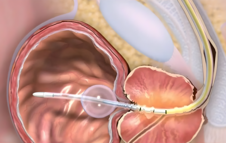 Transüretral mikrodalga tedavisi (TUMT)