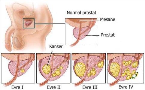 Prostat Kanseri Evreleri (TNM Evrelemesi) Prostat Kanseri Evreleri (TNM Evrelemesi)