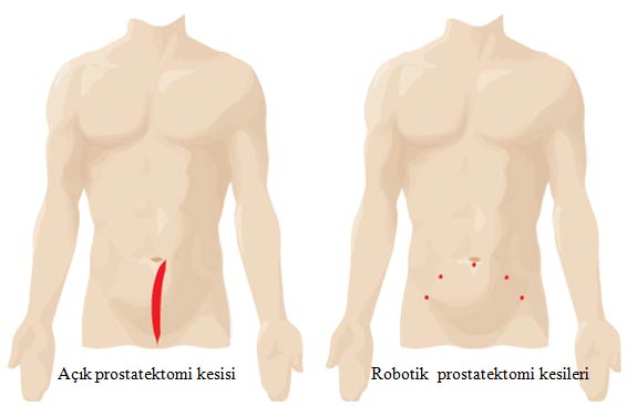 radikal-prostatektomi-yara-izleri