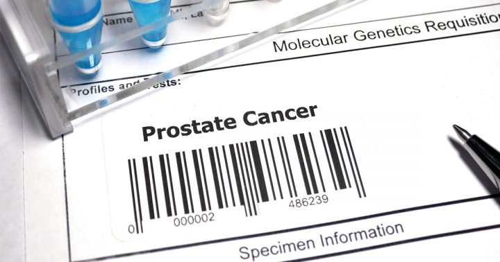 Prostat Kanseri Tedavisinde Son Gelişmeler