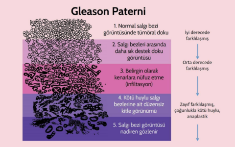 Prostat Kanserinde Gleason Skoru